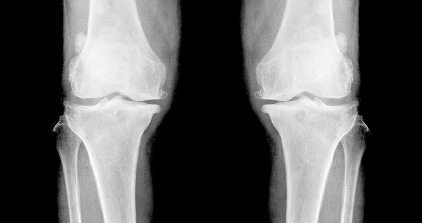 Ka34 Reversing Osteoarthritis